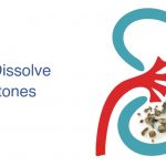 How to dissolve kidney stones