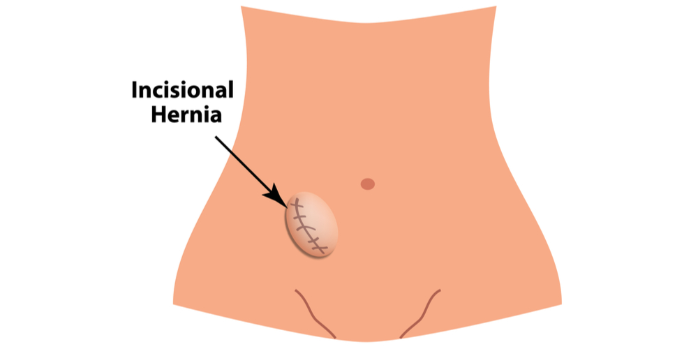 Incisional Hernia
