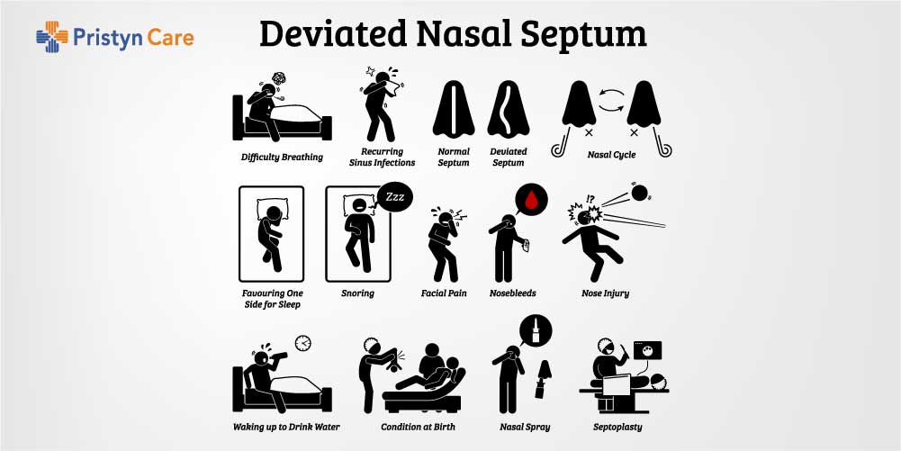 Infographic of a deviated septum