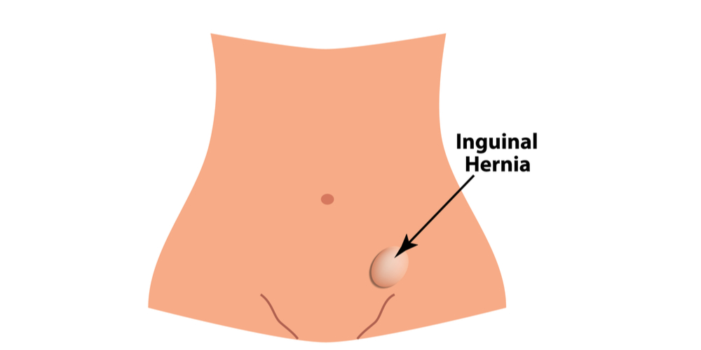 Inguinal Hernia