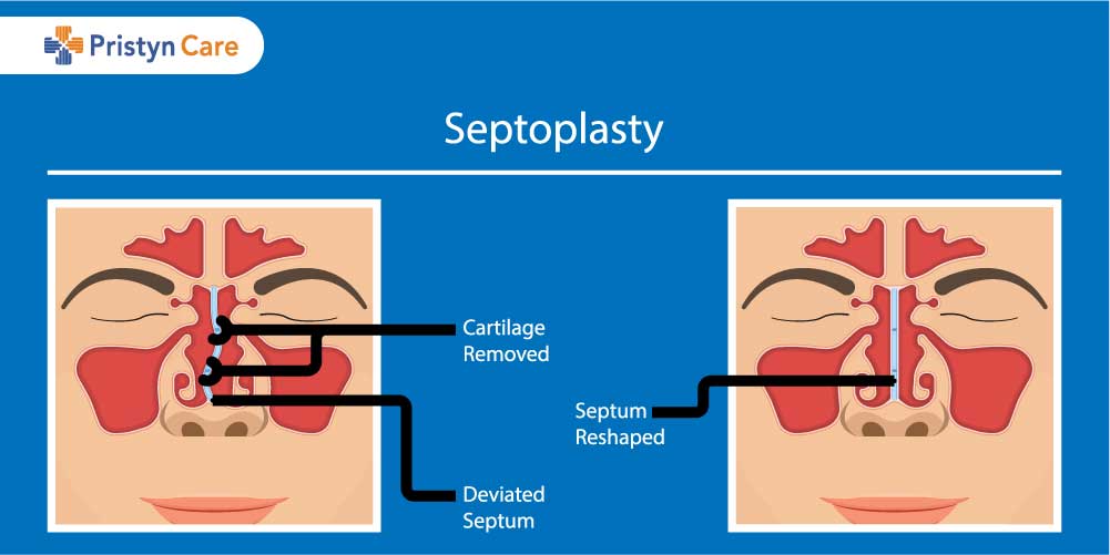 Procedure of septoplasty