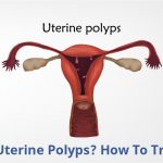 Uterine polyps image