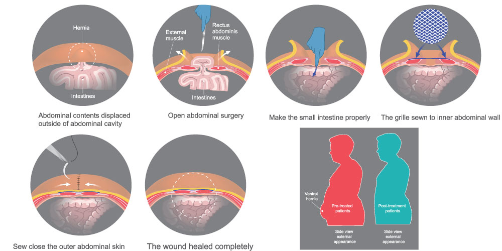 Ventral Hernia