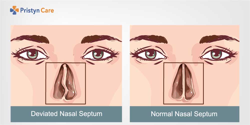 deviated septum vs nasal septum