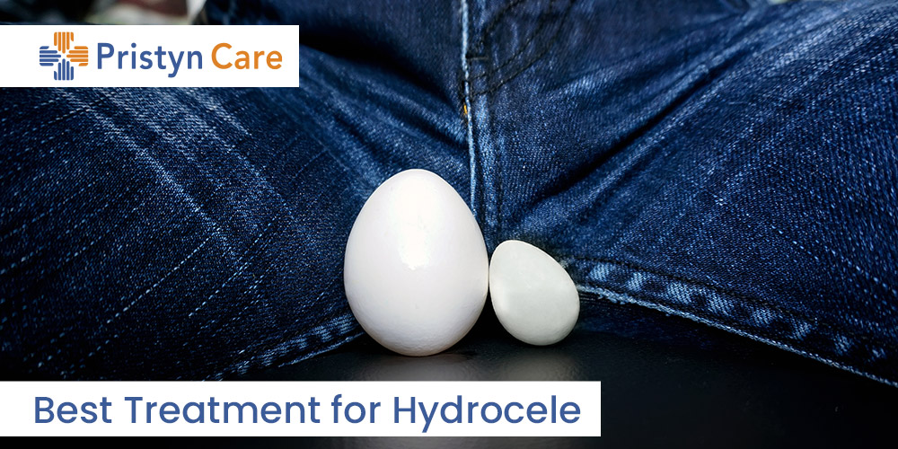 Hydrocele