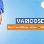 Varicose Veins- How does the pain feel and how to get relief? 