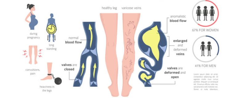 Varicose Veins- How does the pain feel and how to get relief? 