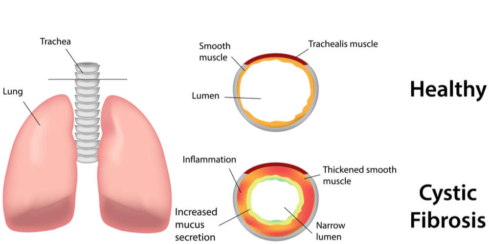 Cystic Fibrosis