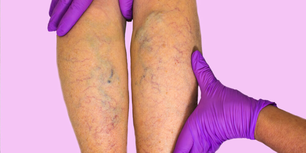 Varicose veins diagnosis