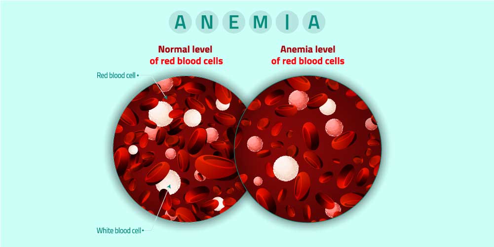 Normal Level anemia