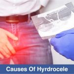 Causes of Hydrocele