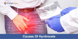 Causes of Hydrocele