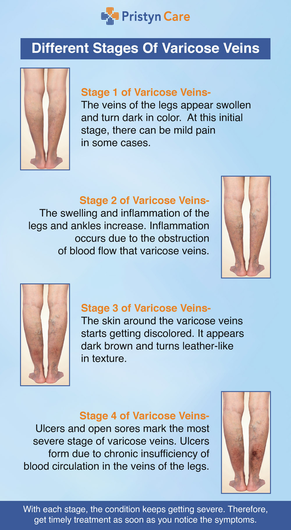 Different stages of varicose veins