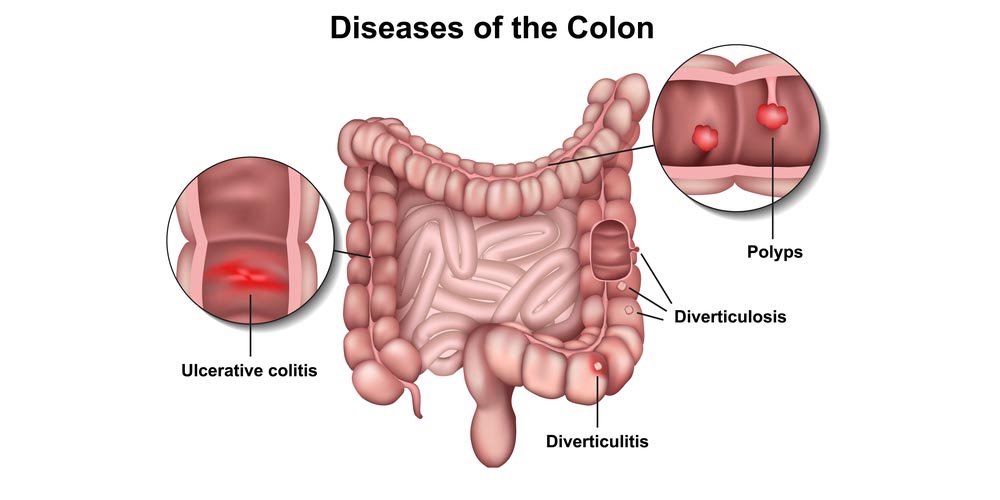 Diseases of the colon