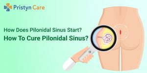 How does pilonidal sinus start