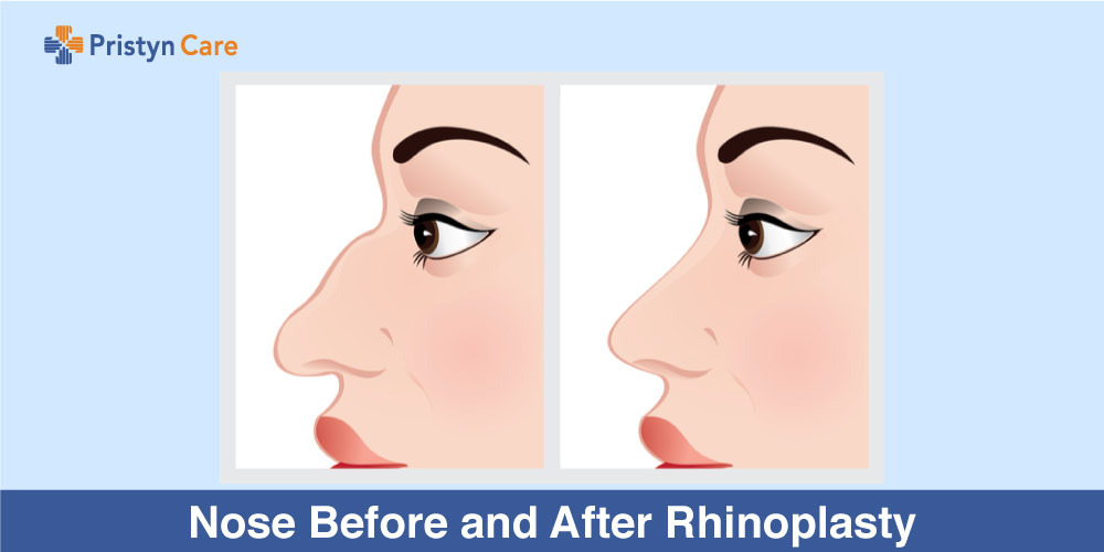 Nose Before and After Rhinoplasty