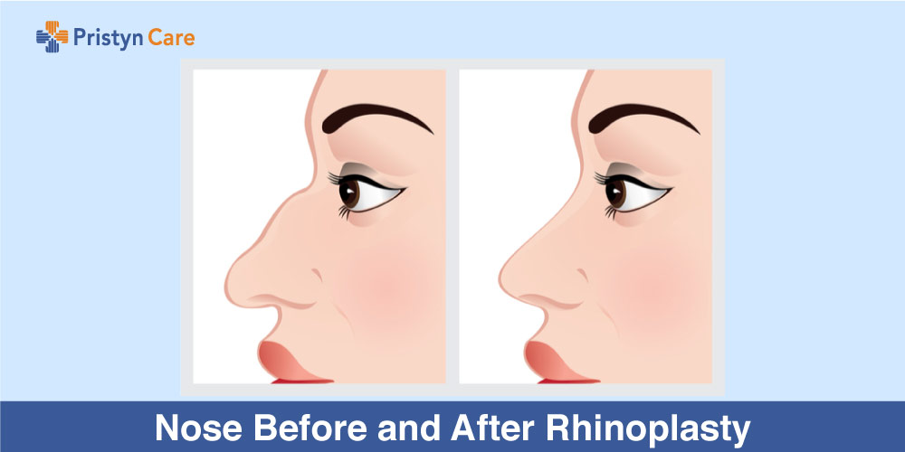 Rhinoplasty