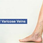 Stages of Varicose veins