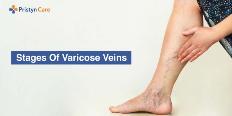 Stages of Varicose veins
