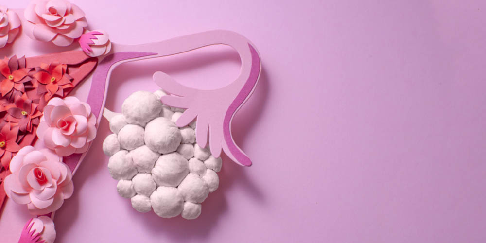 Uterus showing concept of PCOS