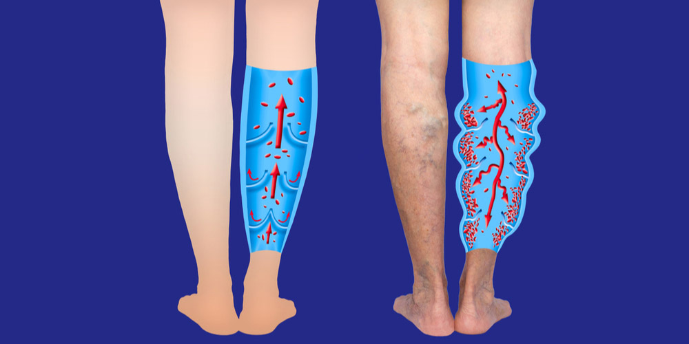 Varicose veins in the legs