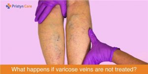 what happens if you leave varicose veins untreated
