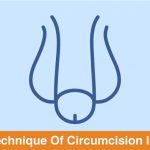 which technique of circumcision is better