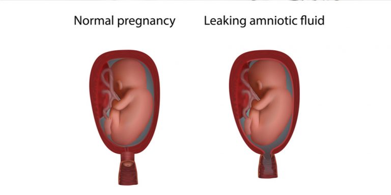 amniotic fluid leak amniotic fluid leak