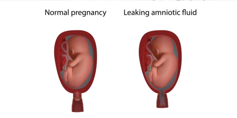 amniotic fluid leak on pad