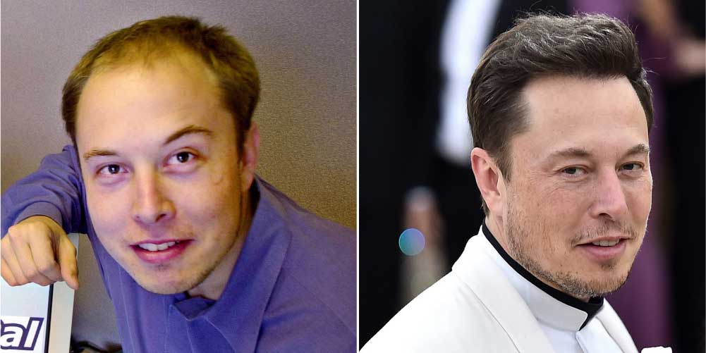 Elon Musk Haartransplantation – Vorher & Nachher