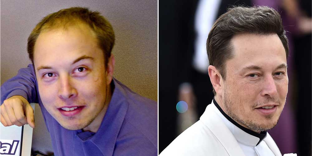 Elon Musk Hair Transplant - Before & After