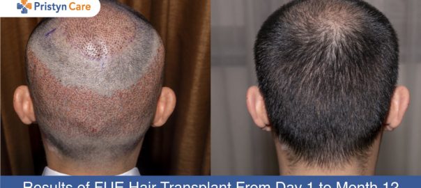 Results of FUE Hair Transplant From Day 1 to Month 12