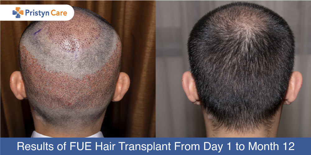 Hair Transplantation Before & After Results