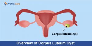 Overview of Corpus Luteum Cyst 
