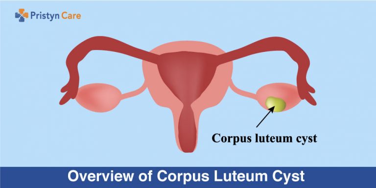 Overview of Corpus Luteum Cyst 