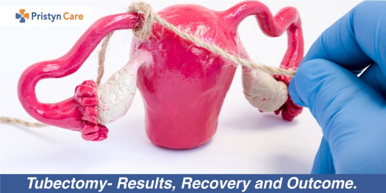Tubectomy- Results, Recovery and Outcome. 