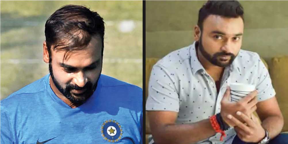 Amit Mishra Before & After Hair Transplantation