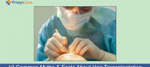13 Common Myths and Facts About Hair Transplantation