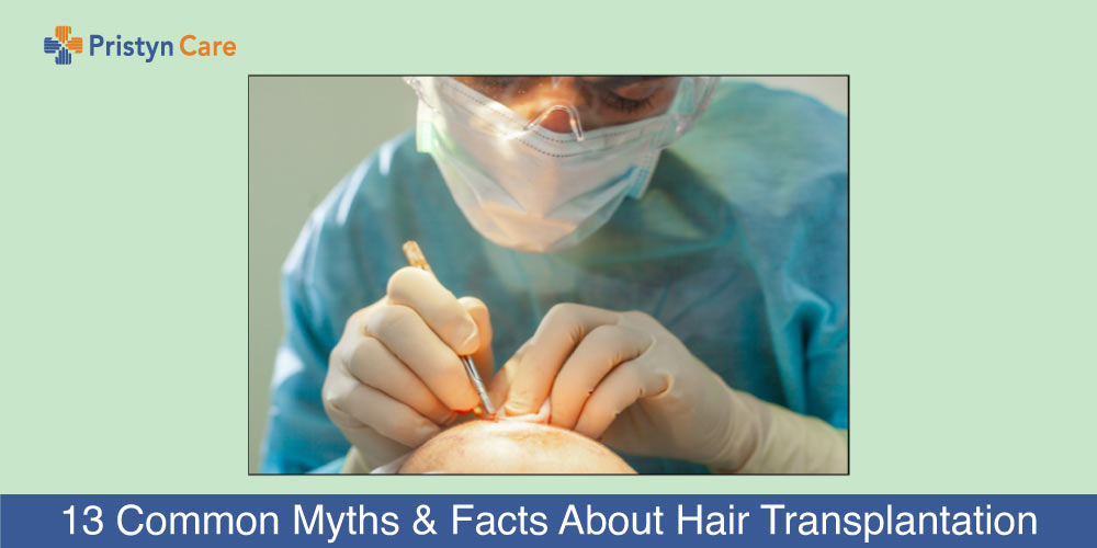 Myths and Facts about Hair Transplantation