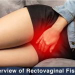 female in pain suffering from rectovaginal fistula