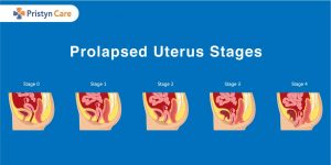 Prolapsed uterus stages