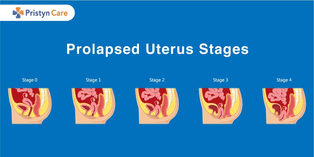 Prolapsed Uterus Stages Pristyn Care