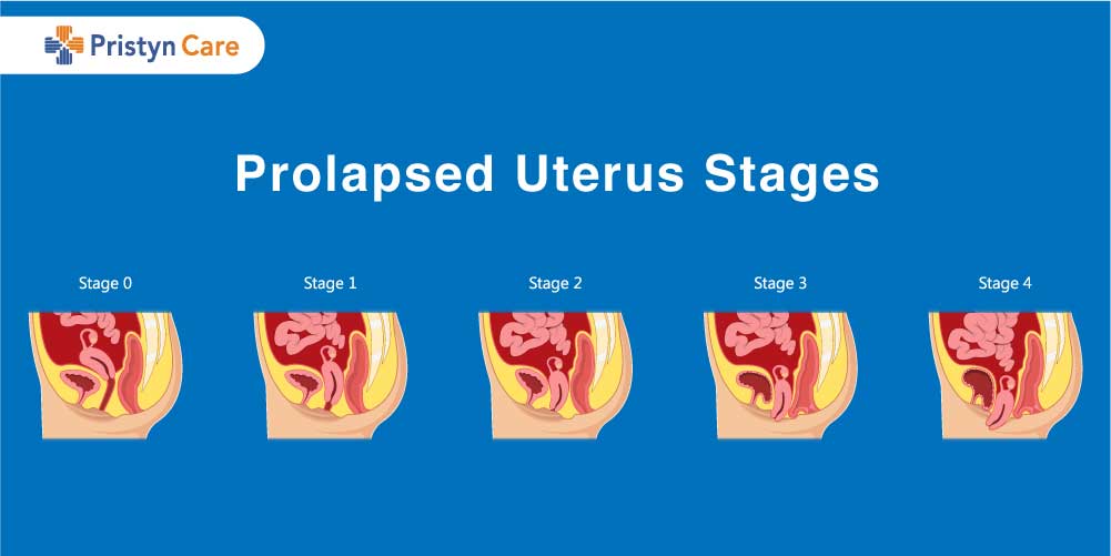 Prolapsed Uterus Stages - Pristyn Care