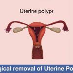 Surgical removal of Uterine Polyps