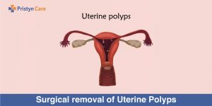 Surgical removal of Uterine Polyps