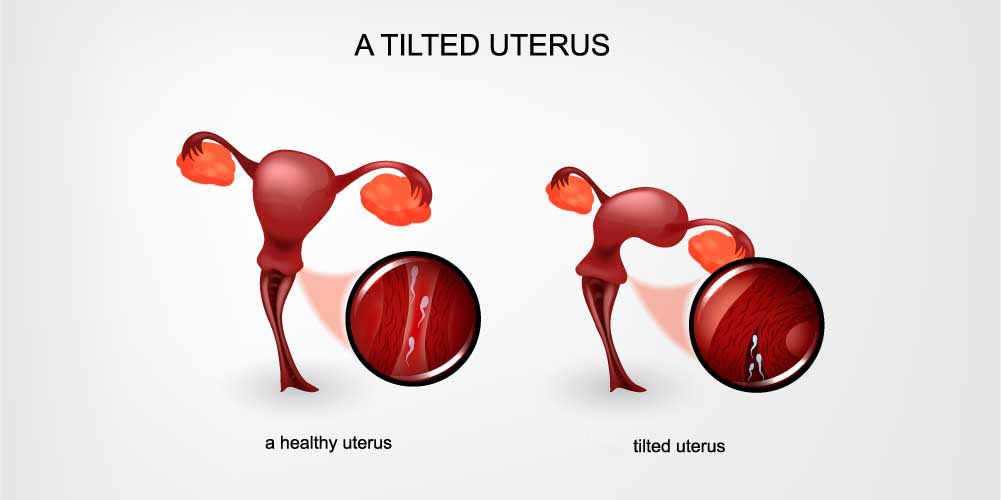 tilted uterus