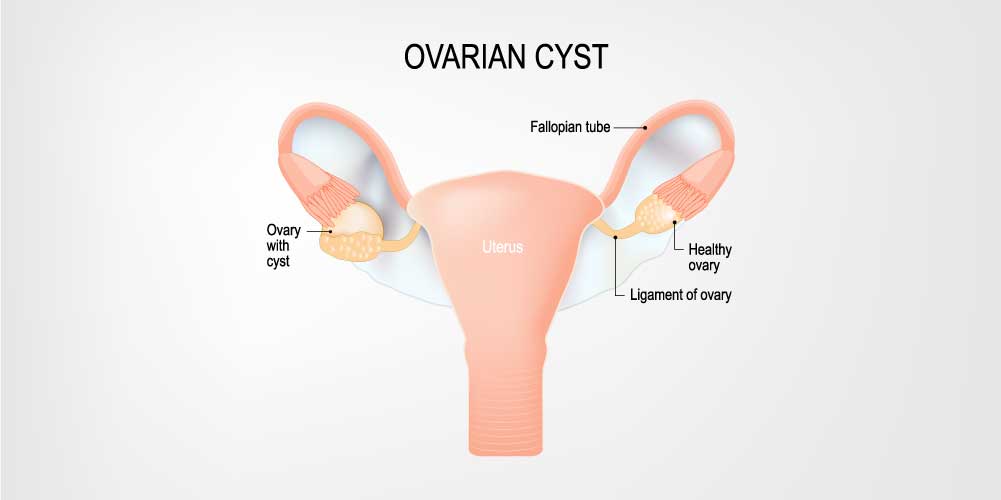 What causes lower abdominal pain in females?