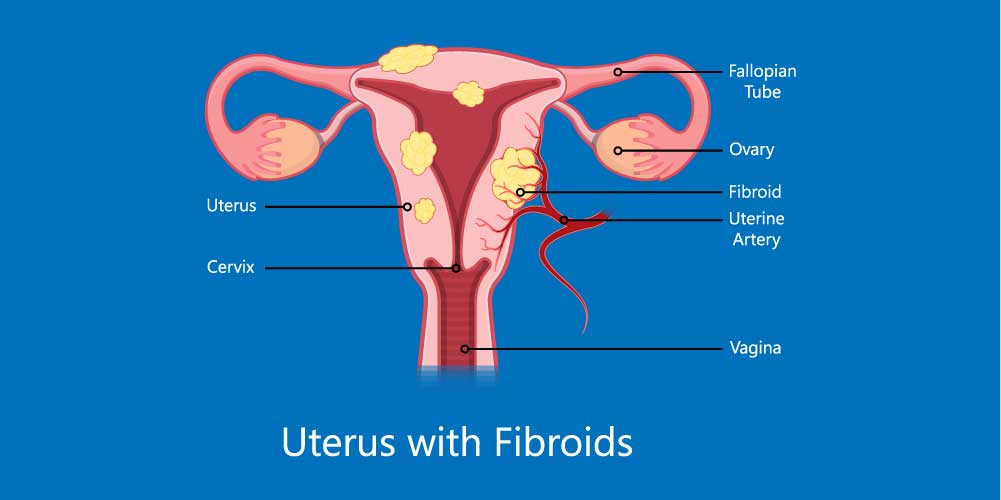 Uterine Fibroids