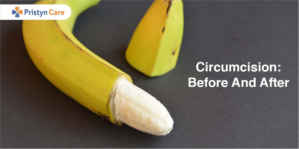 Circumcision Before And After 