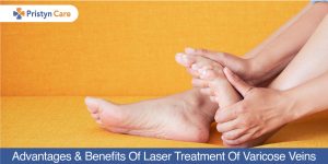 benefits of laser treatment for varicose veins